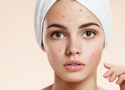Woman with acne scarring