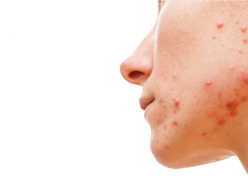 Person's face with acne