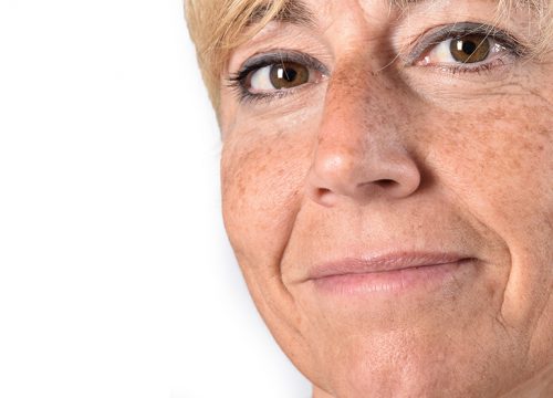 Woman with age spots on her face