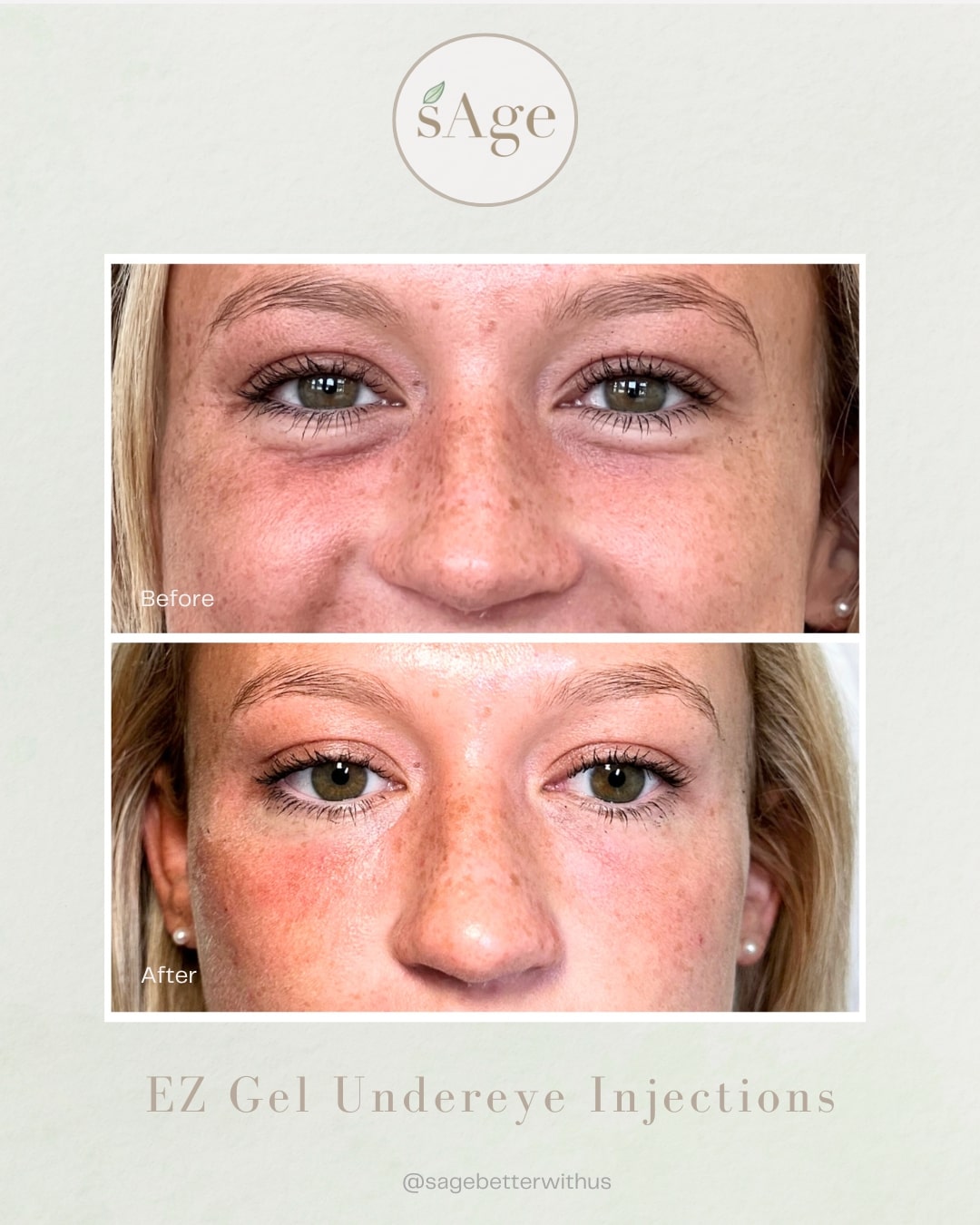 Before and after ezGel filler results